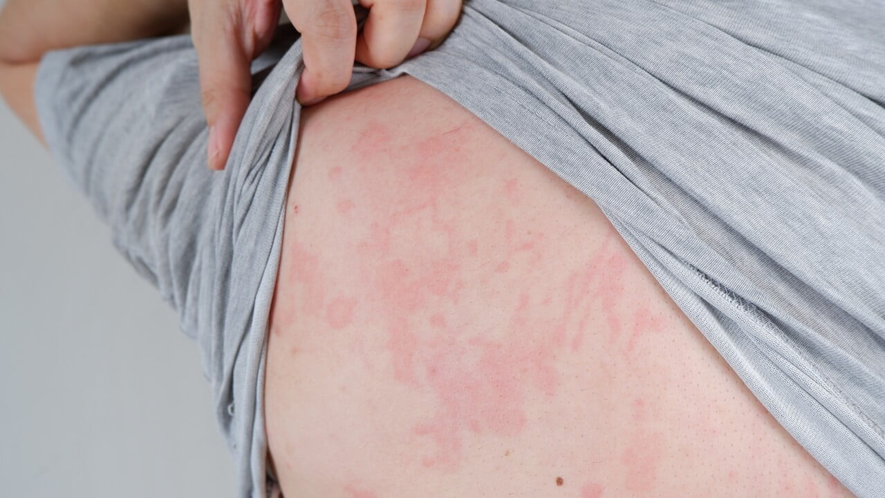 ALLERGIC REACTIONS AND ANAPHYLAXIS
